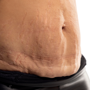 Image of a stomach with loose skin