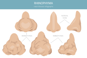 Nasal disease infographic