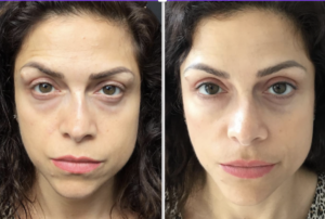Before and after Polynucleotide treatment