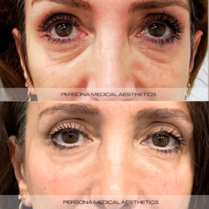 Before & after DF Tear Trough