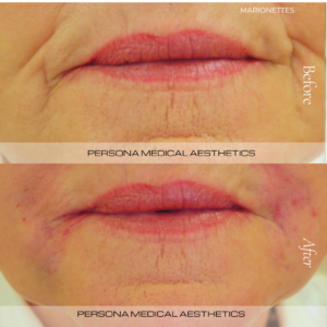 Before & after Marionette Filler