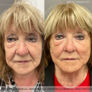 Before & after Thread Lift 1