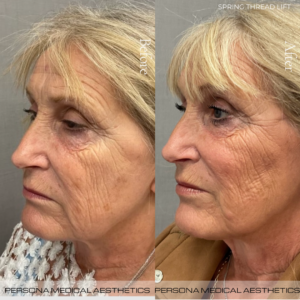 Before & after Thread Lift