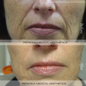 Beofre & after Nasolabial folds
