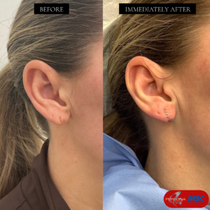 Earlobe repair Persona Medical Aesthetics, MSC, The Braham Institute, Dr Braham Ouali