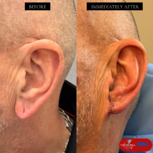 Earlobe repair Persona Medical Aesthetics, MSC, The Braham Institute, Dr Braham Ouali