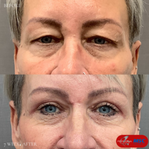 Upper Blephartoplasty Persona Medical Aesthetic, MSC, The Braham Institute, Dr Braham Ouali