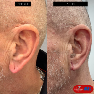 BEFORE & AFTERS PCM & MSC