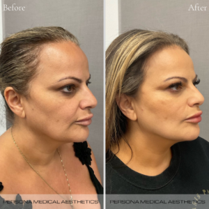 Before and After Instagram Post (1)