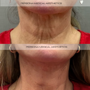 Before and After Instagram Post (2)