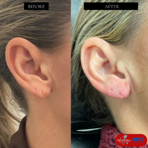 Earlobe Repair Perspna Medical & MSC