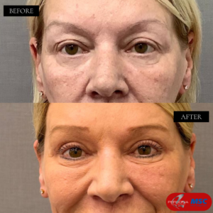 Upper Belpharoplasty Persona Medical Aesthetics Monor surgery Clinic