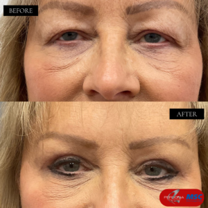 Upper Blepharoplasty Personamedical aesthetics MSC